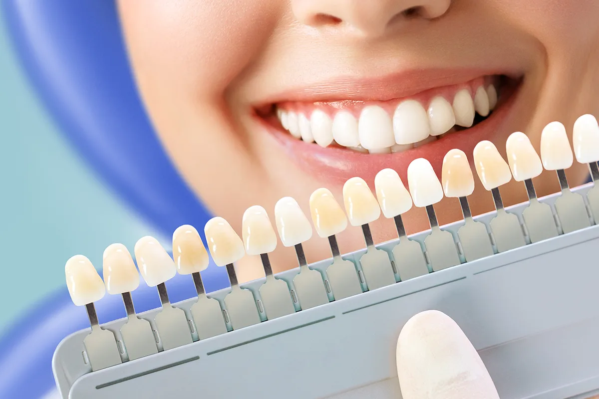Porcelain Veneers in Houston
