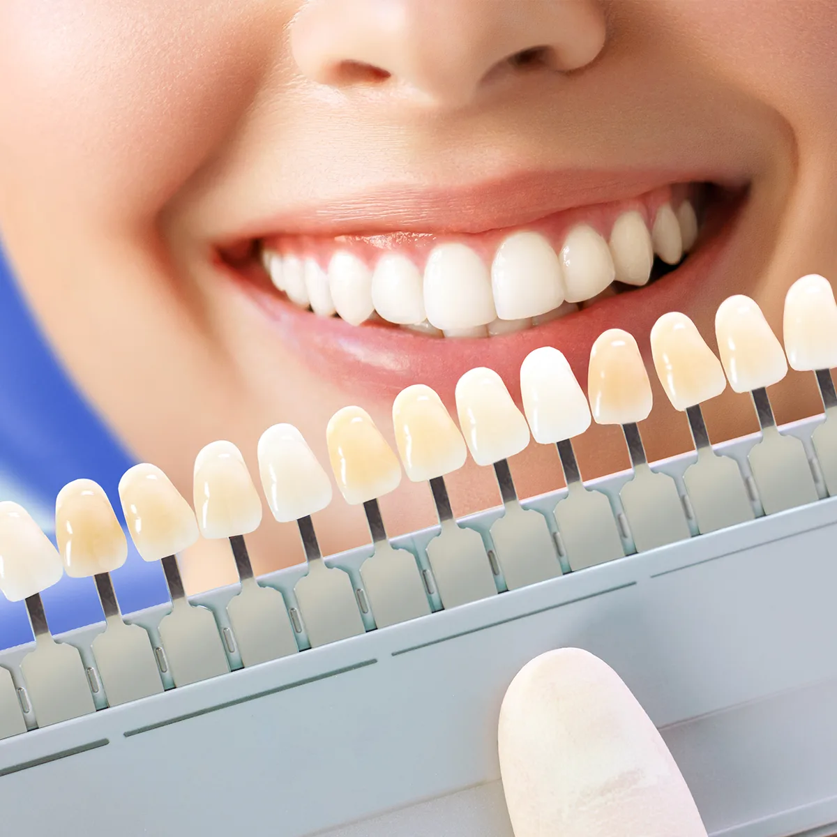 Veneers